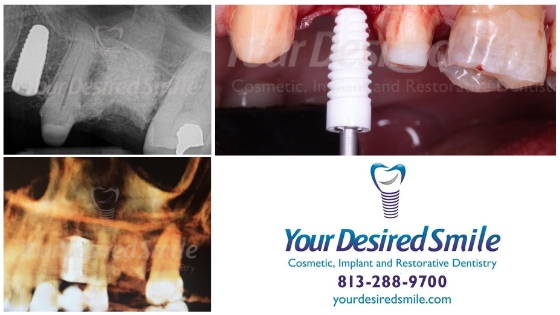 Guided Placement of ZERAMEX XT using 3Shape after removal of infected root canal tooth