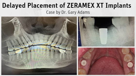 Delayed Placement of ZERAMEX XT Implants