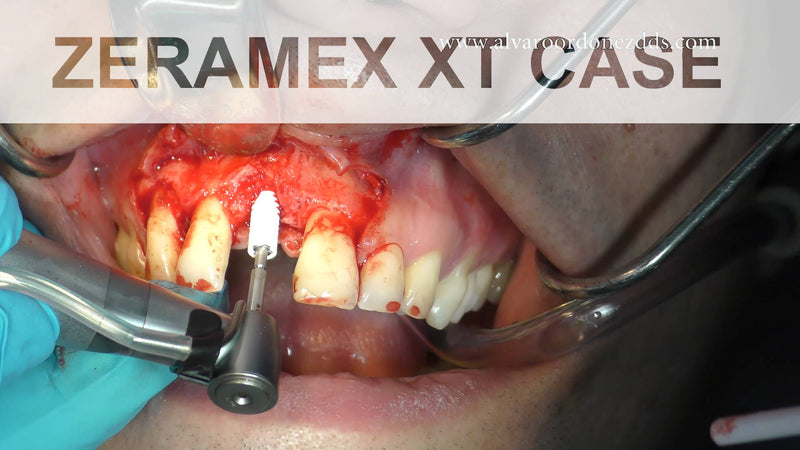 ZERAMEX XT Tapered Ceramic Implant placed in Narrow Ridge