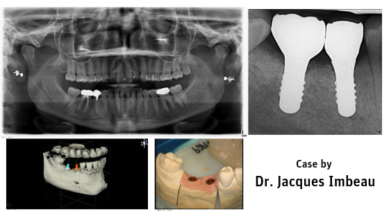 ZERAMEX P6 Implant Placement