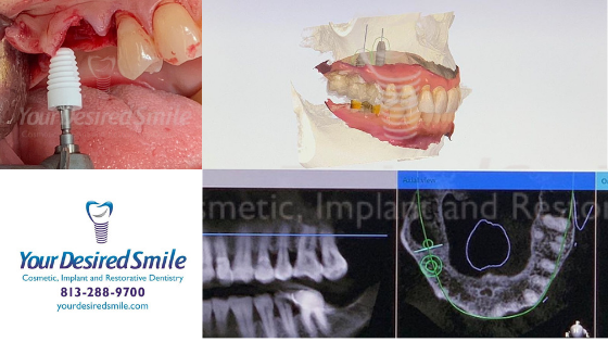 Posterior Zirconia Implants Guided Surgery