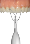 Safe Relax Automatic Crown and Bridge Remover by ANTHOGYR