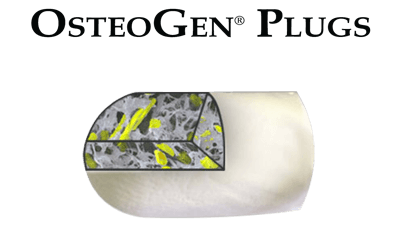 OsteoGen Plug - Bone Grafting Plug